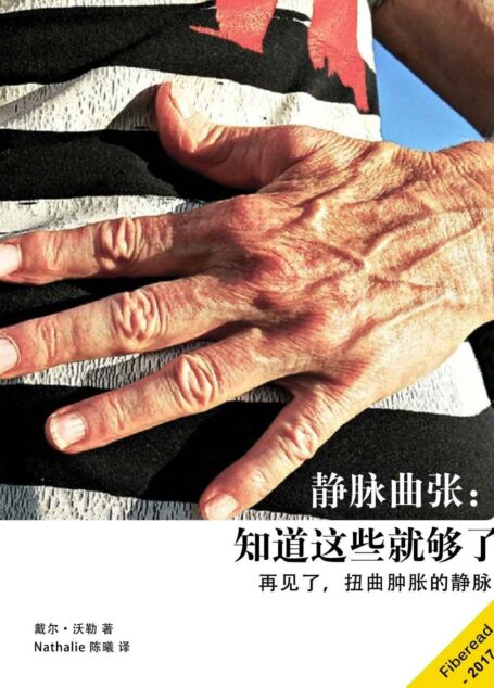 静脉曲张:知道这些就够了(再见了,扭曲肿胀的静脉)